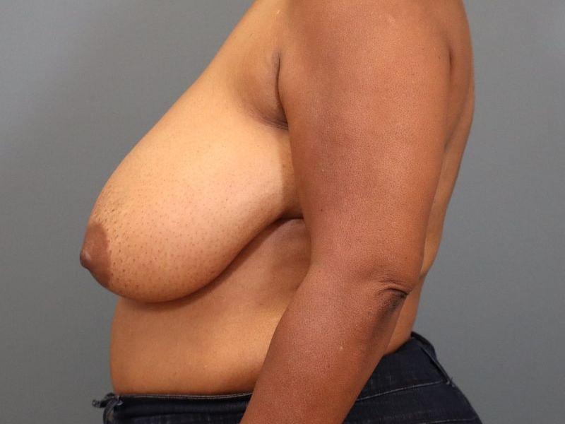 before breast reduction left side view of female patient 5827 close up