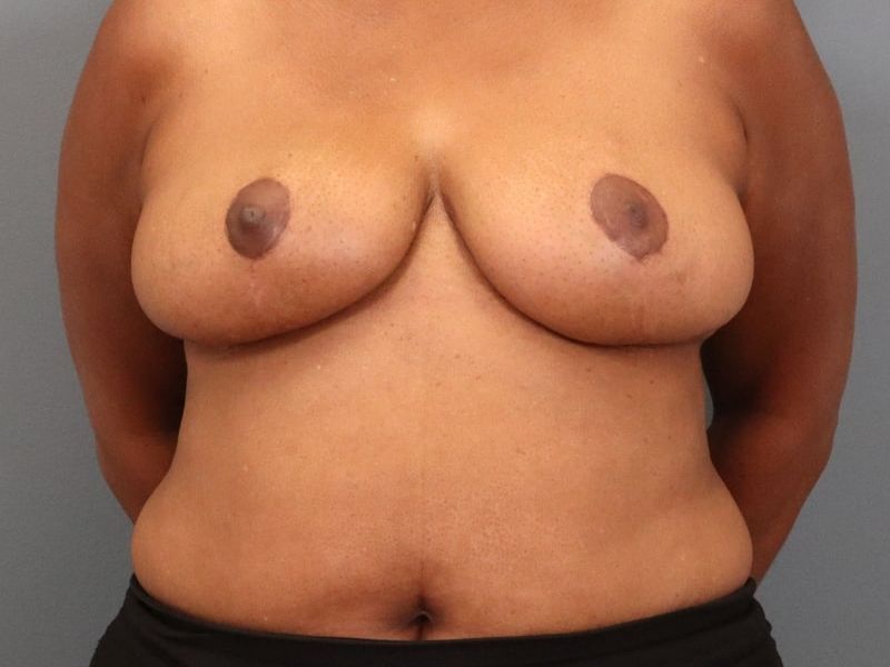 after breast reduction front view of female patient 5827 close up