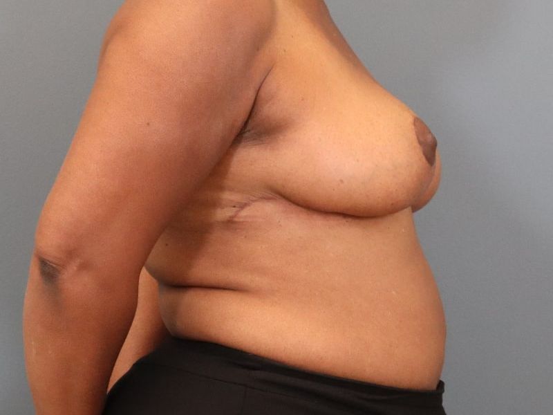 after breast reduction right side view of female patient 5827 close up